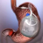 Cirugía de balón gástrico