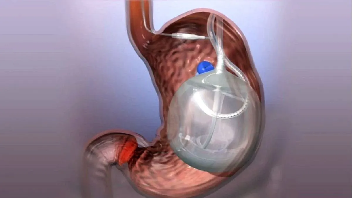 Procedimientos endoscópicos bariátricos para bajar de peso